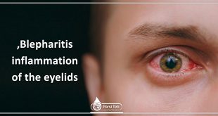 Blepharitis , inflammation of the eyelids