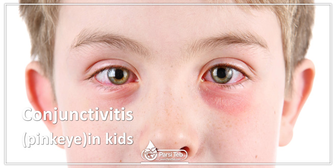 Conjunctivitis (pinkeye)in kids
