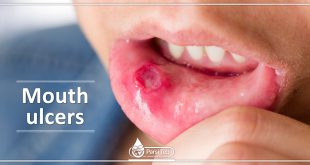 Mouth ulcers