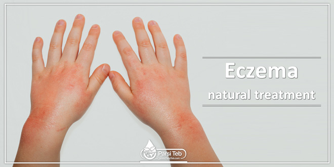 eczema natural treatment