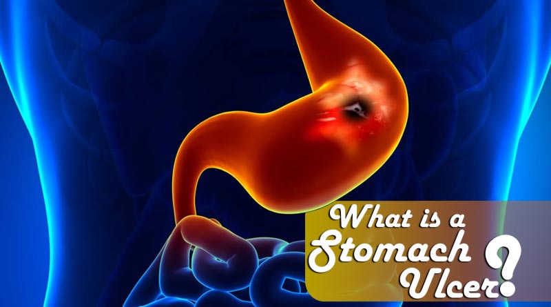 What is a stomach ulcer? - ParsiTeb :: Herbal Medicine