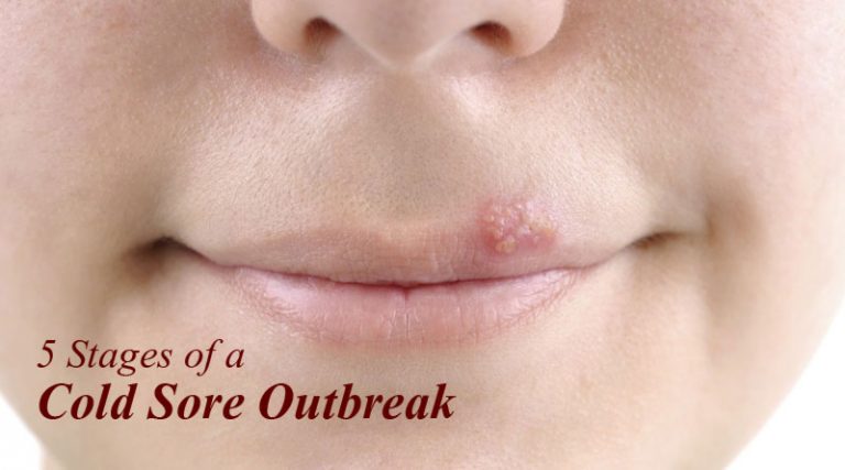 5-stages-of-cold-sores-outbreak-parsi-teb