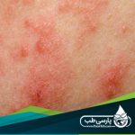 Eczema treatment