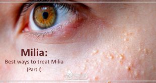 What is Milia?